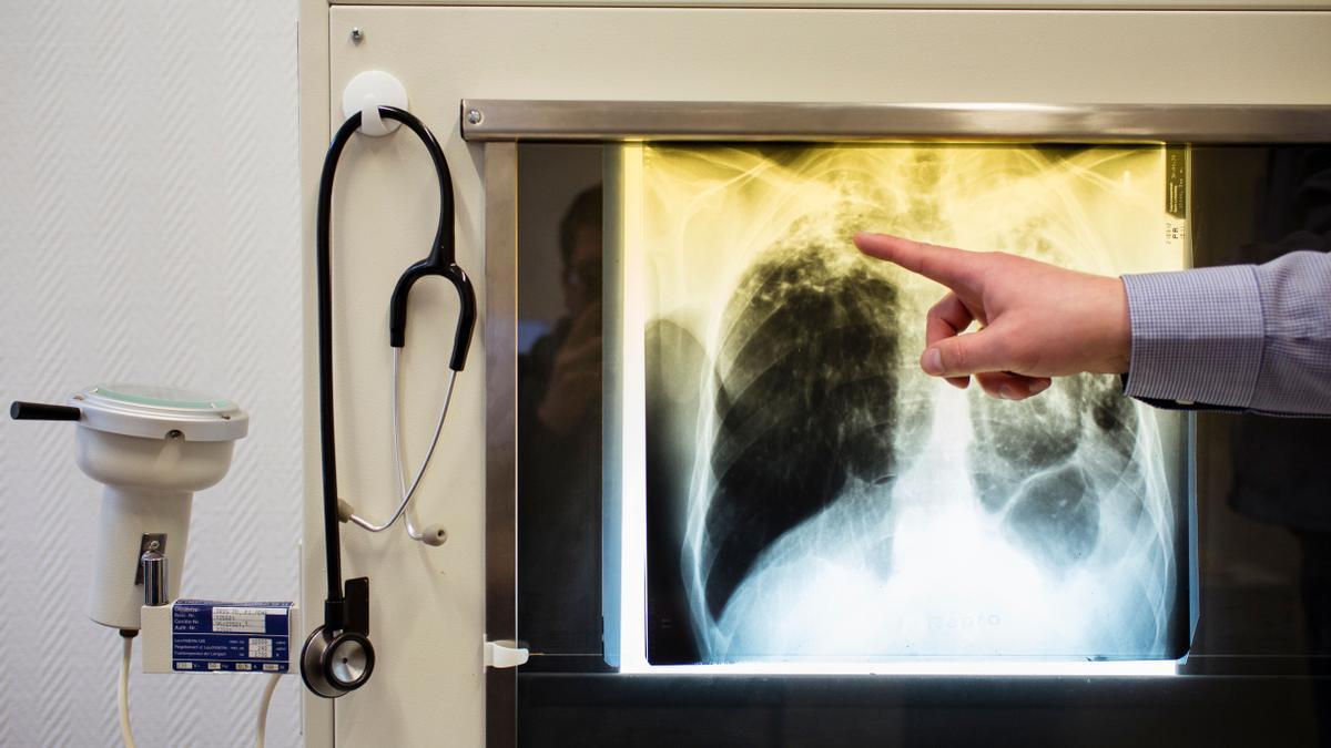 tuberculosis pediátrica