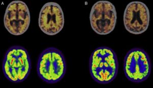 síntoma temprano de alzheimer
