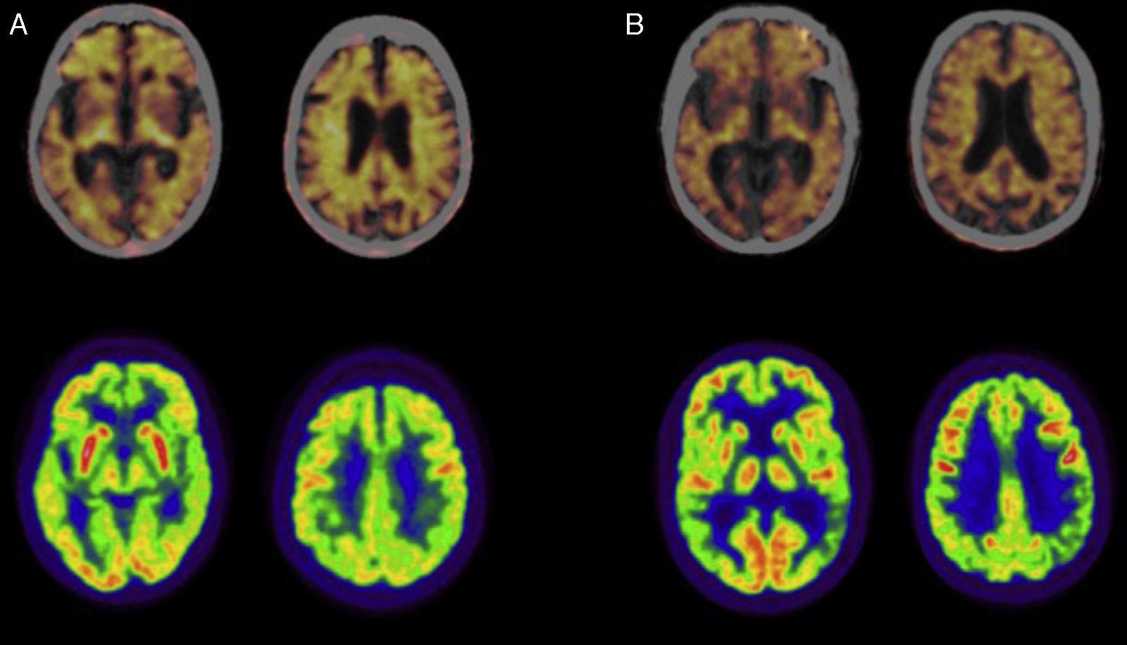 sintoma temprano de alzheimer