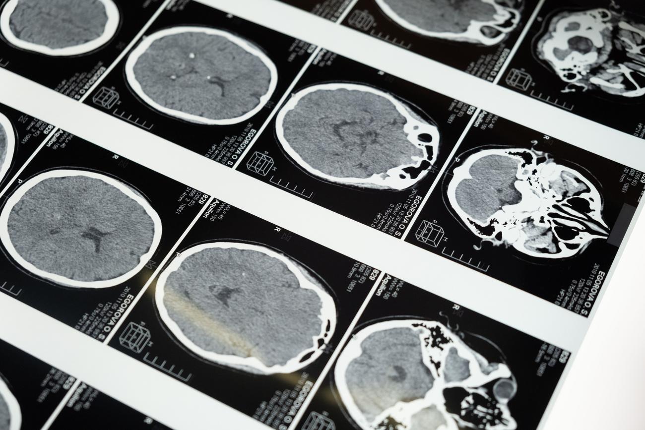 Imágenes detalladas de resonancia magnética (MRI) del cerebro humano mostradas en un negatoscopio médico, ideal para ilustrar la conectividad neuronal.