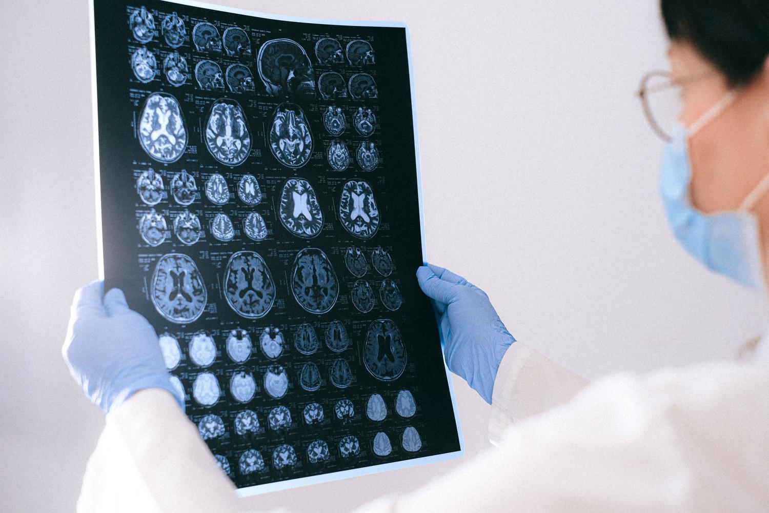 Médico neurólogo analizando los resultados de una resonancia magnética del cerebro.