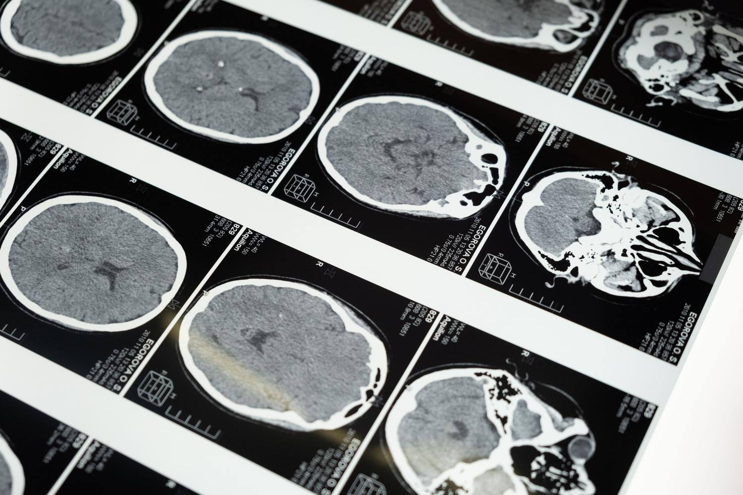 Imágenes de resonancia magnética cerebral en un negatoscopio, representando el proceso de diagnóstico neurológico.