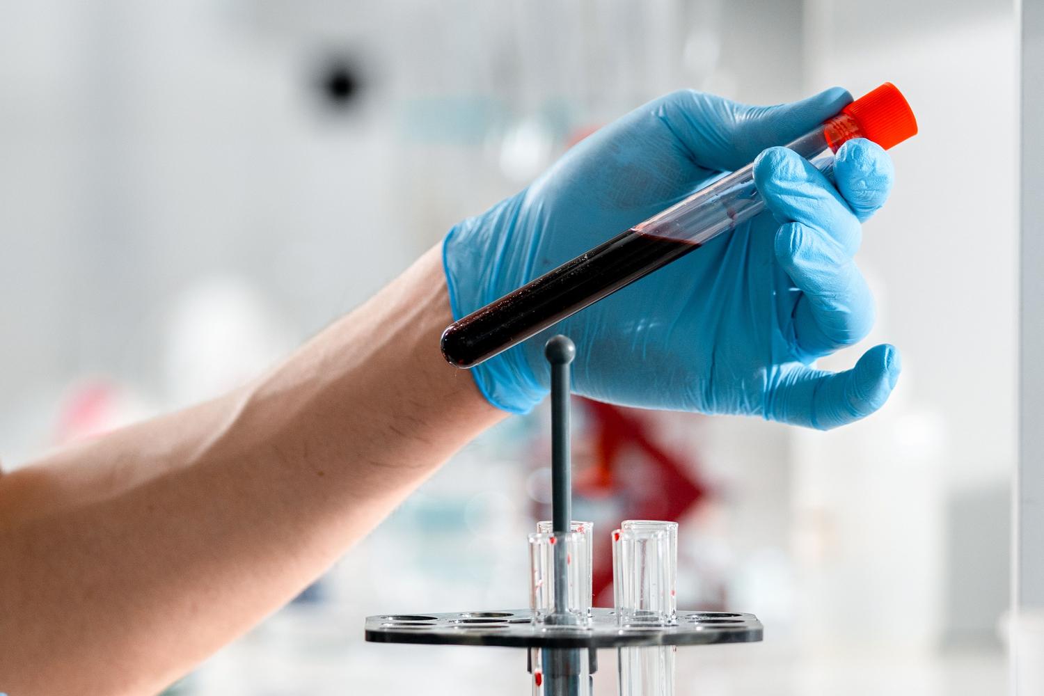 Primer plano de tubos de ensayo con muestras de sangre en un laboratorio clínico, representando el análisis de lipoproteína(a).