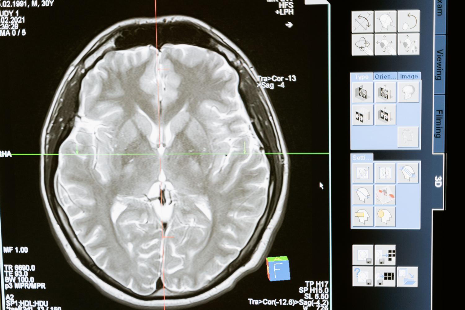Imagen detallada de un escaneo cerebral de resonancia magnética mostrada en una pantalla de computadora para análisis médico.